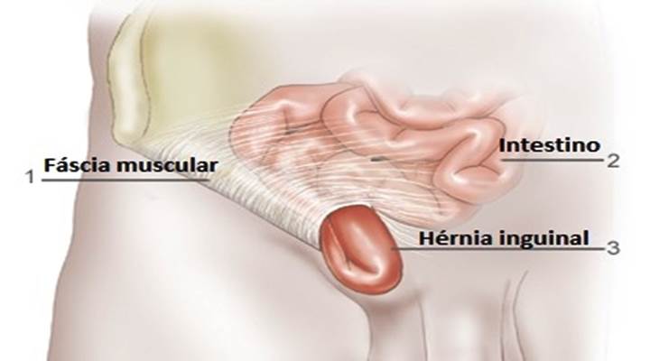 Hernia Inguinal causas
