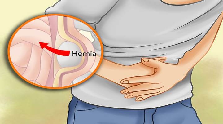 hernias causas